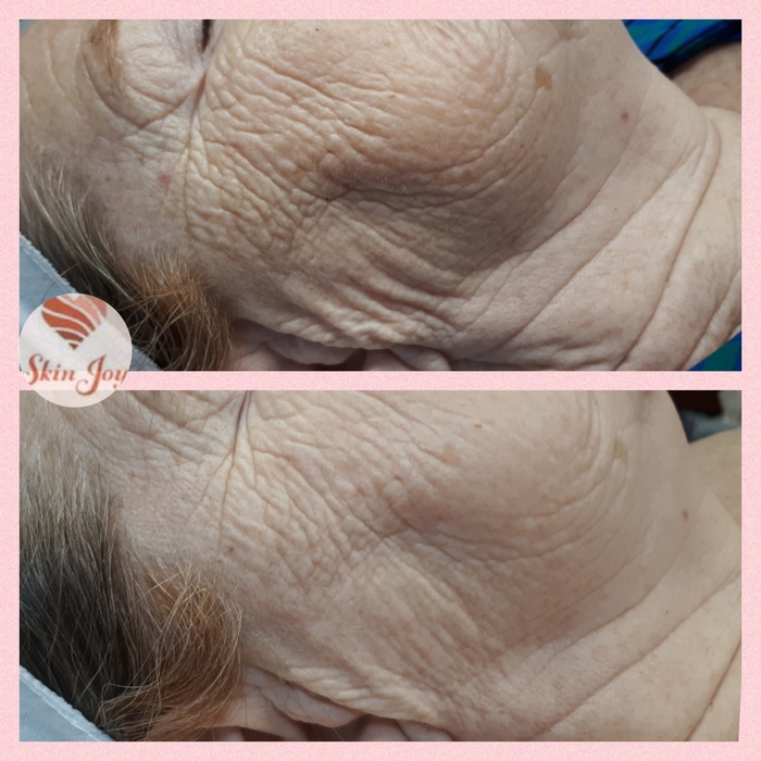 AMG Procell for sagging & wrinkling 1